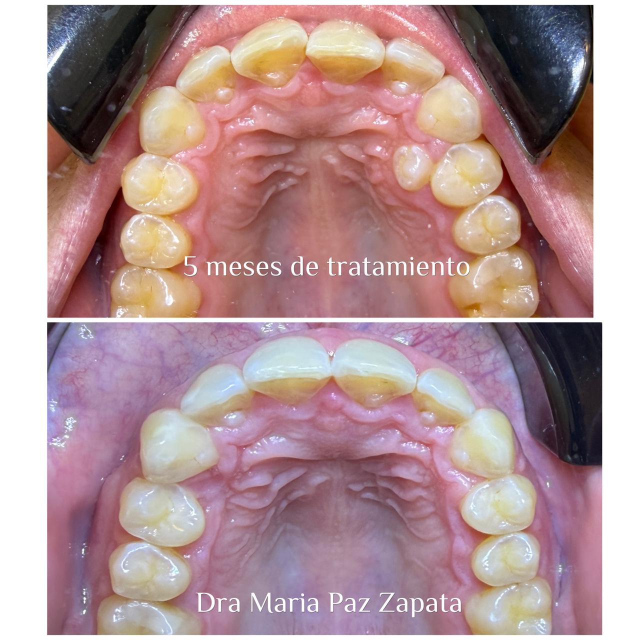 Caso tratado con Auraline en 5 meses, vista oclusal antes y después