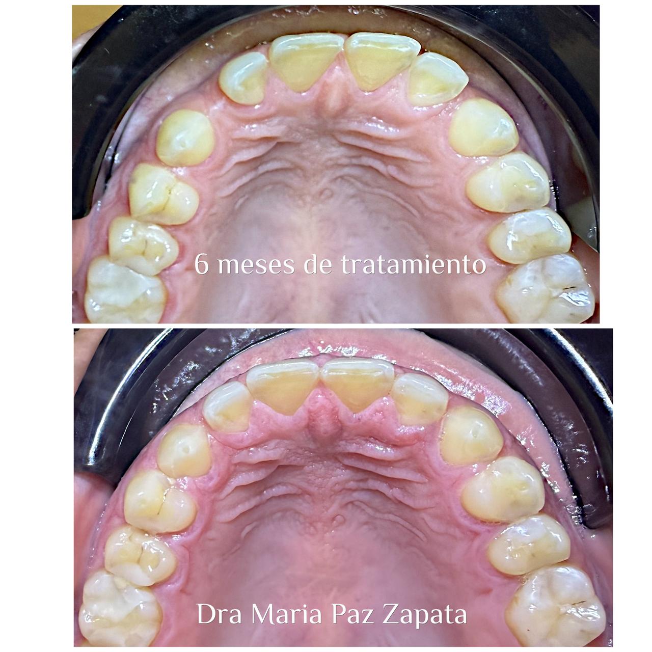 Caso tratado con Auraline en 6 meses, vista oclusal antes y después
