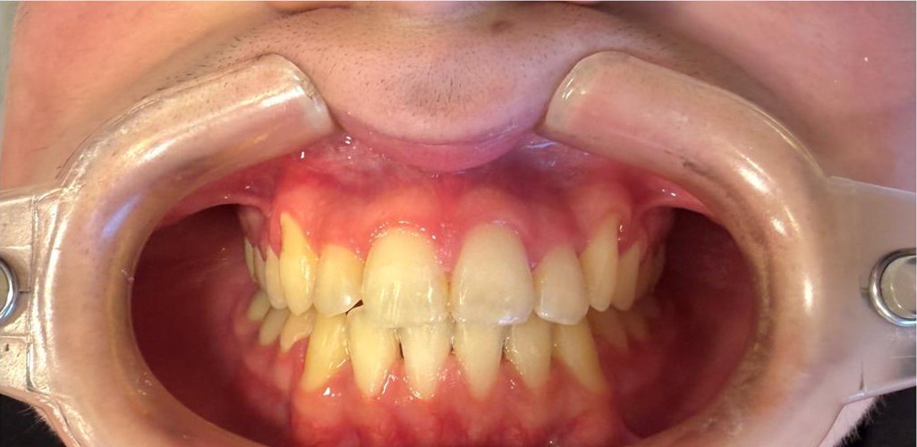 Sonrisa después de 12 meses de tratamiento con Auraline
